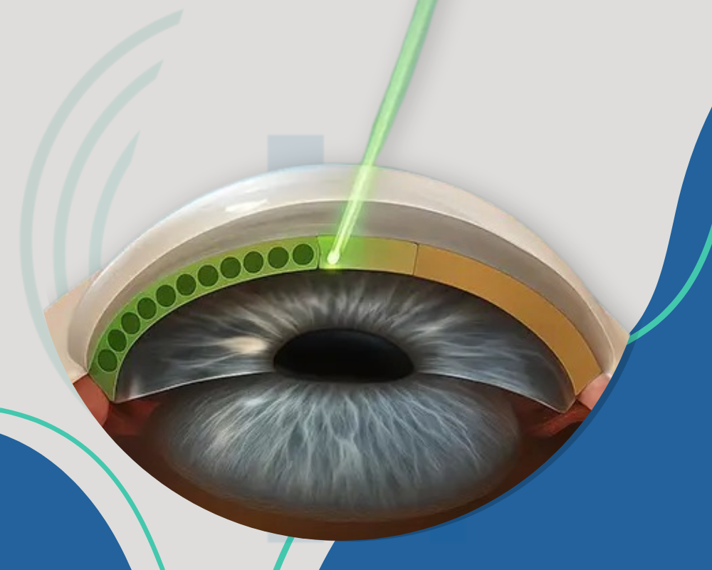 Glaucoma e estrabismo