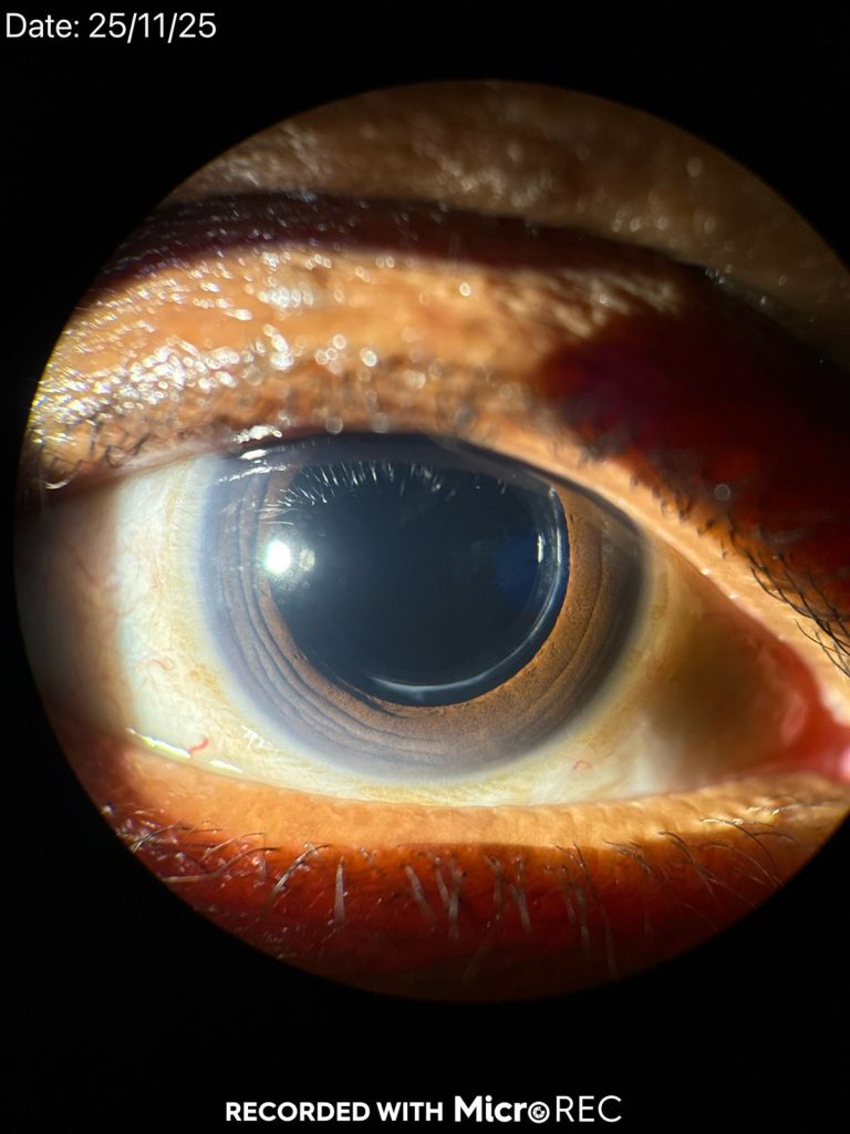 Cirurgia de catarata